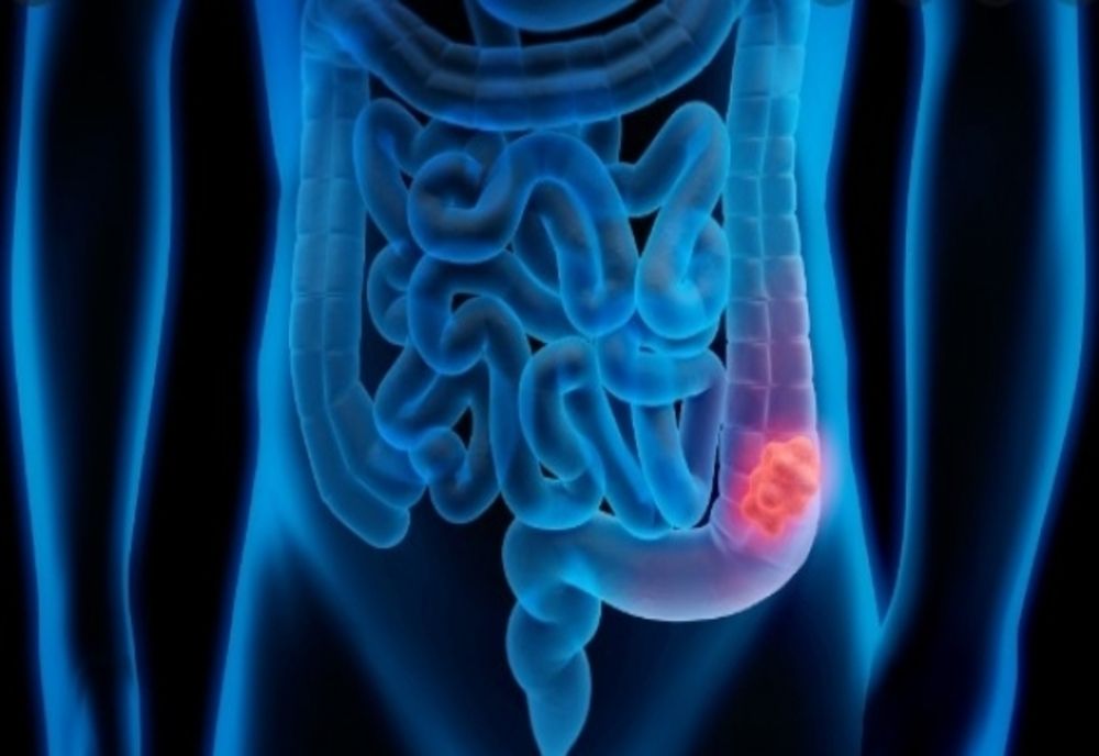 Testare gratuită pentru depistarea cancerului colorectal pentru vârstnicii din parohiile bucureștene și ilfovene