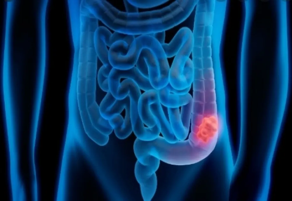 Testare gratuită pentru depistarea cancerului colorectal pentru vârstnicii din parohiile bucureștene și ilfovene