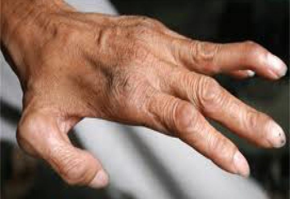 Un nou caz de lepră a fost confirmat la Cluj-Napoca. Sunt primele două cazuri înregistrate în România din 1981